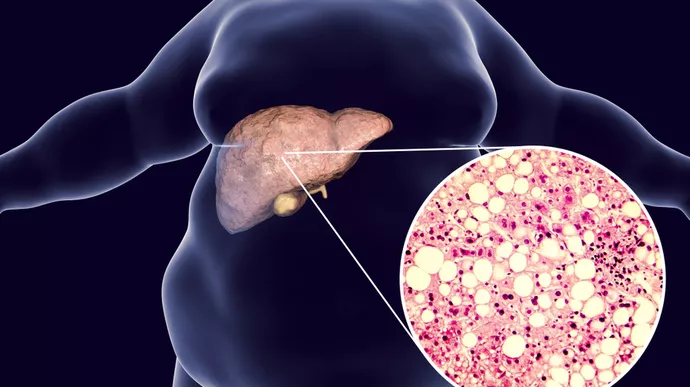 Fatty liver disease illustration showing fat accumulation in liver cells and enlarged liver