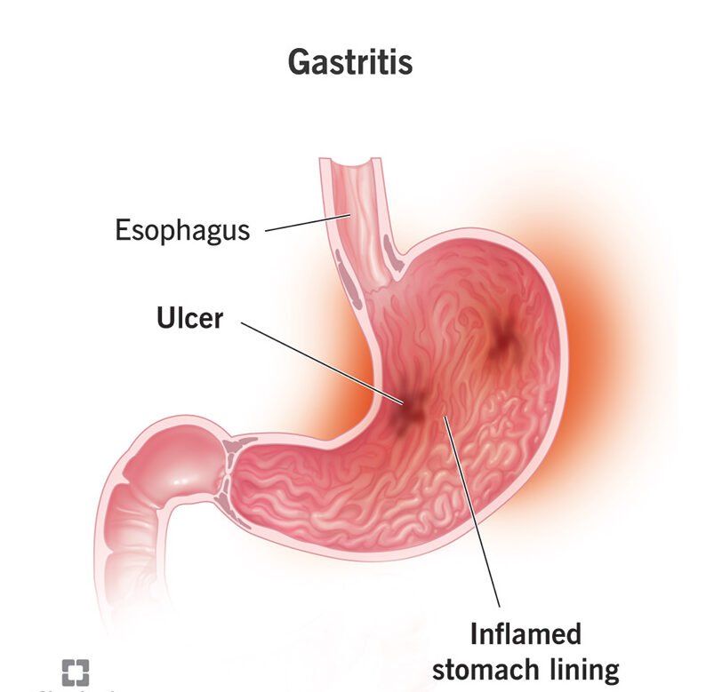 Gastritis treatment illustration showing inflamed stomach lining and ulcer