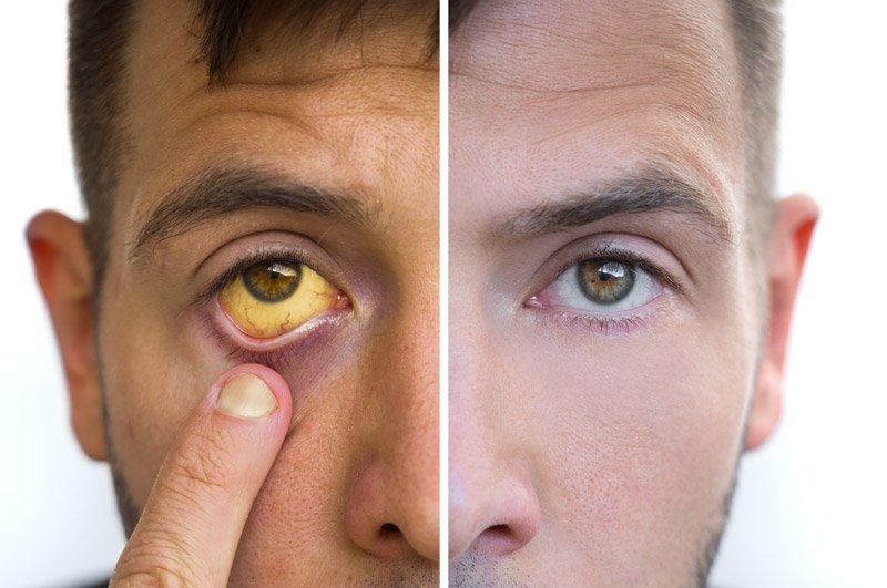 Before and after comparison of jaundice showing yellow eyes caused by liver disease