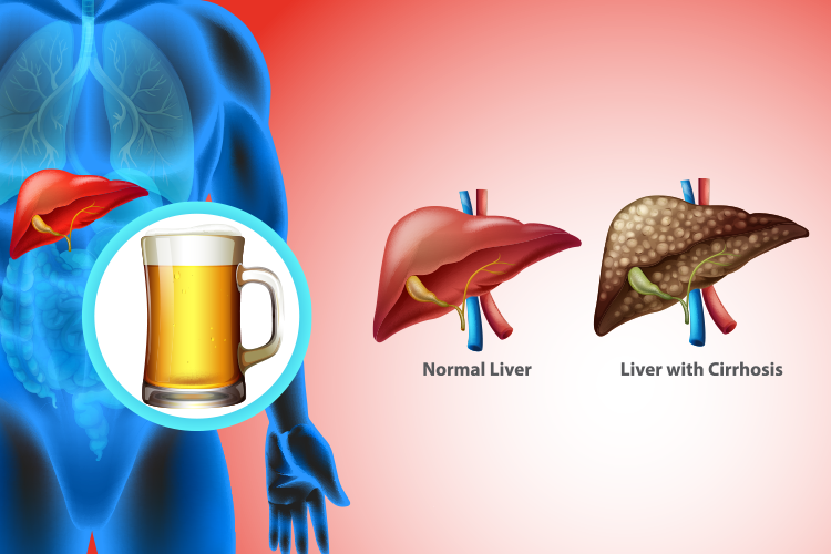 Alcoholic liver disease illustration showing beer consumption and comparison between normal liver and cirrhosis liver