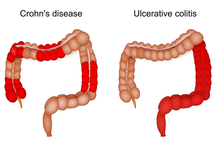 Comparison of Crohn’s disease and ulcerative colitis showing inflamed areas in colon and digestive tract