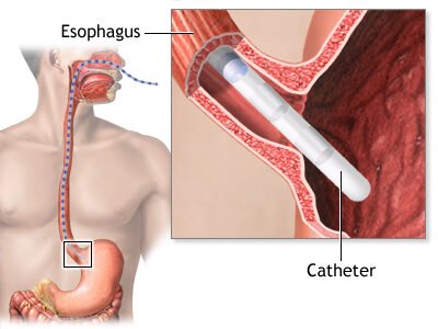 Esophageal manometry test showing catheter inserted into esophagus to measure swallowing and muscle function