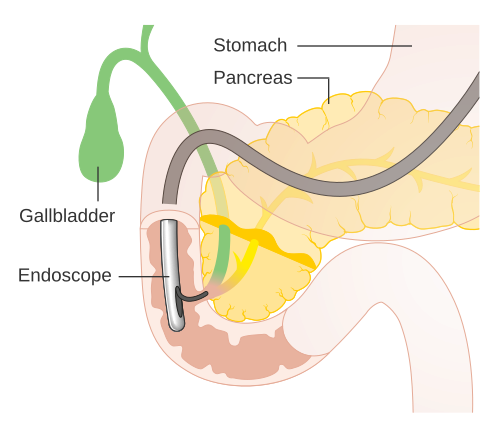 ERCP procedure illustration for gallbladder, pancreas and bile duct treatment