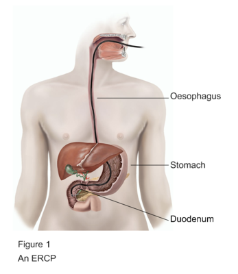ERCP procedure diagram showing oesophagus stomach and duodenum treatment