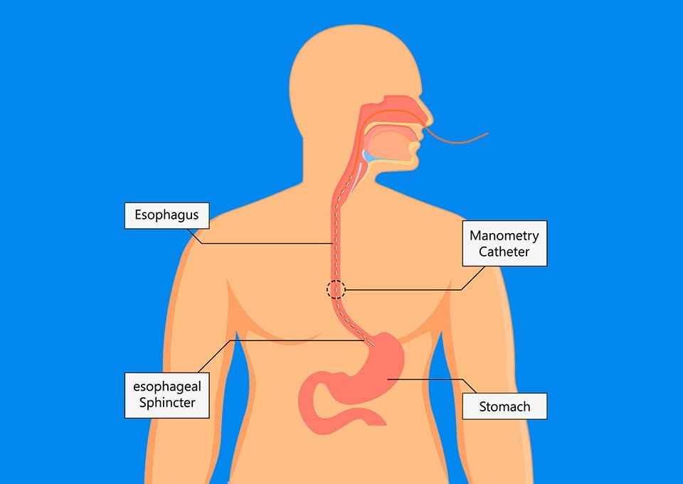Esophageal manometry test illustration showing catheter inserted through nose into esophagus to measure pressure and swallowing function