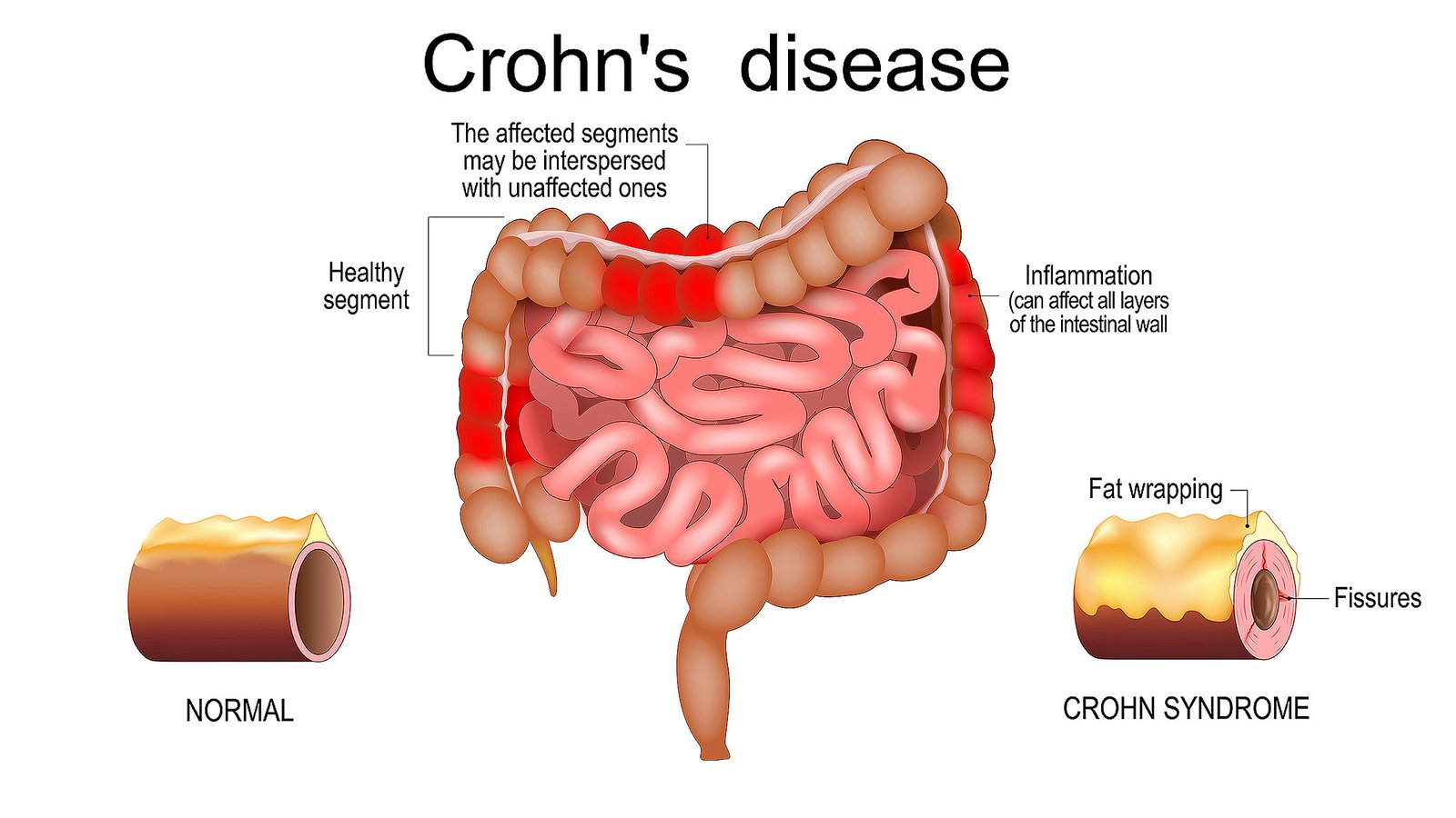 Crohn’s disease illustration showing inflamed intestine, healthy segments, fissures, and fat wrapping in digestive tract
