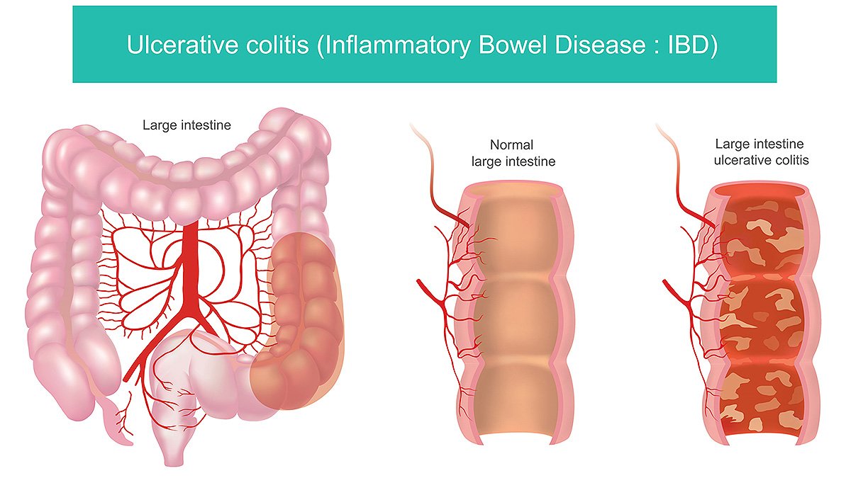 Ulcerative colitis inflammatory bowel disease diagram showing normal colon and inflamed large intestine