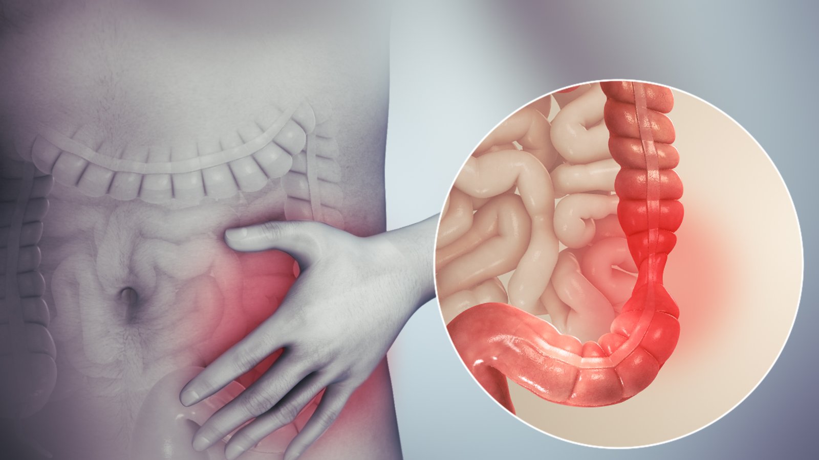 Irritable Bowel Syndrome (IBS) treatment illustration showing inflamed colon and abdominal pain symptoms