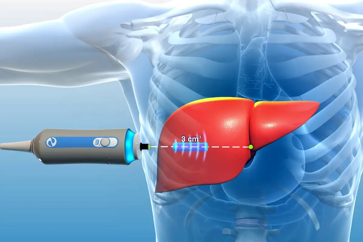 Fibroscan test for liver fibrosis and fatty liver diagnosis