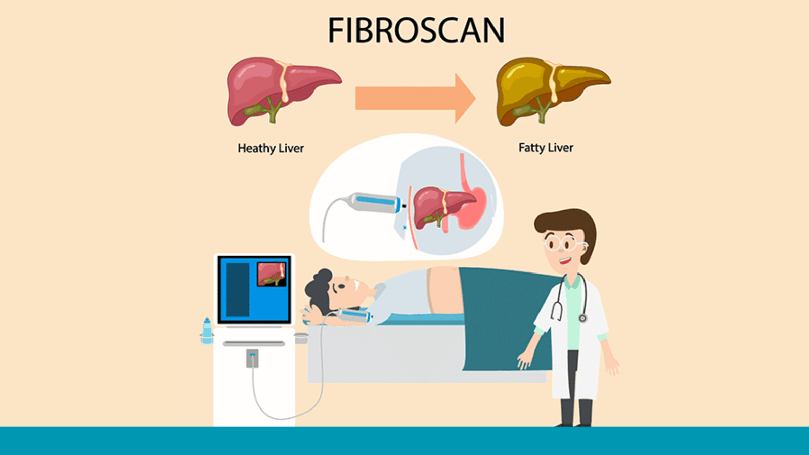 Fibroscan test for fatty liver diagnosis and liver health check