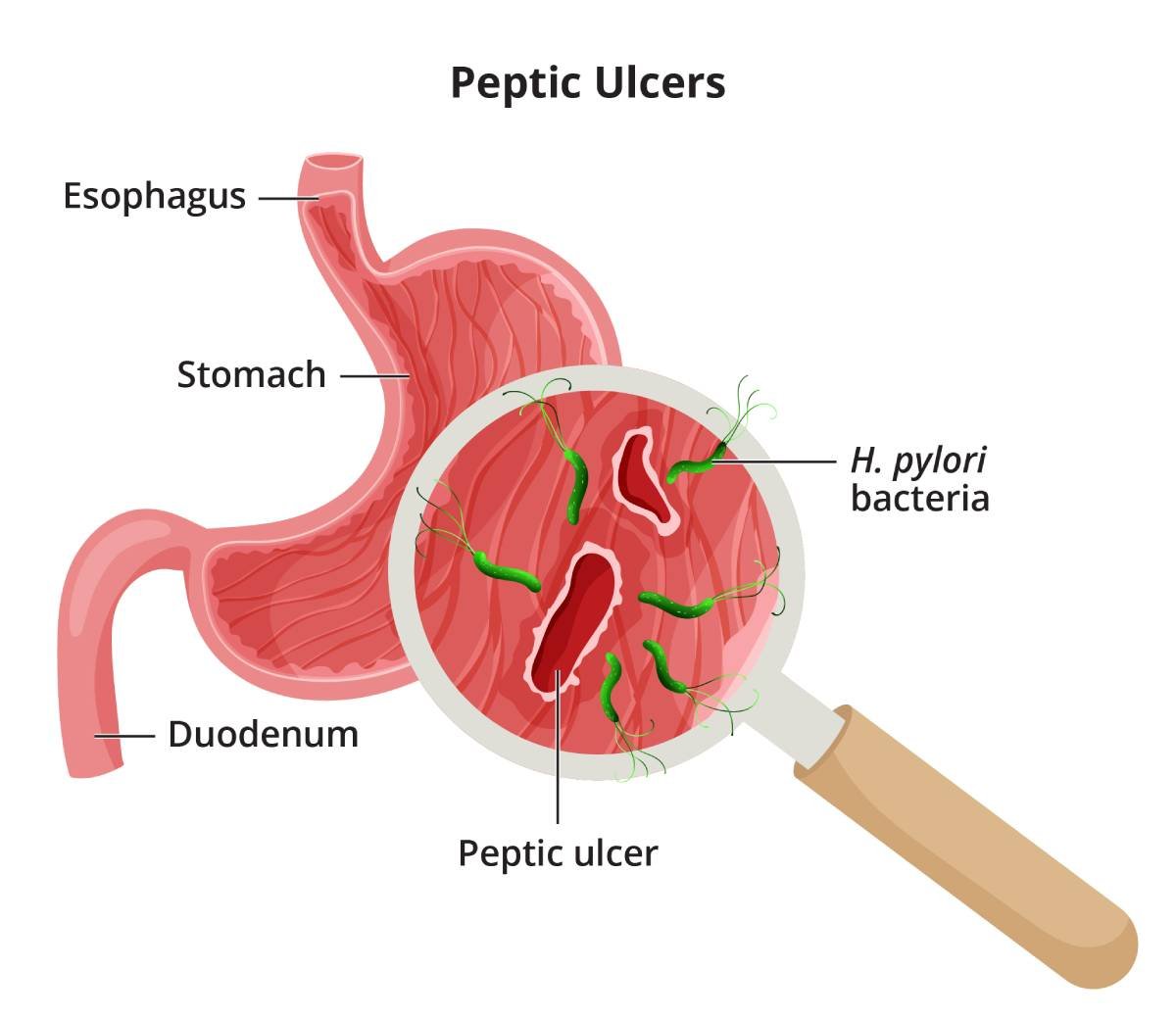 Peptic ulcer and H pylori infection illustration for stomach ulcer treatment