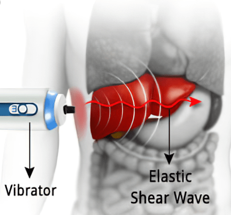 Fibroscan test showing liver stiffness measurement using elastic shear wave