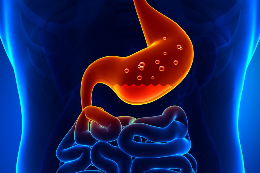 Gastritis treatment illustration showing inflamed stomach lining and acidity
