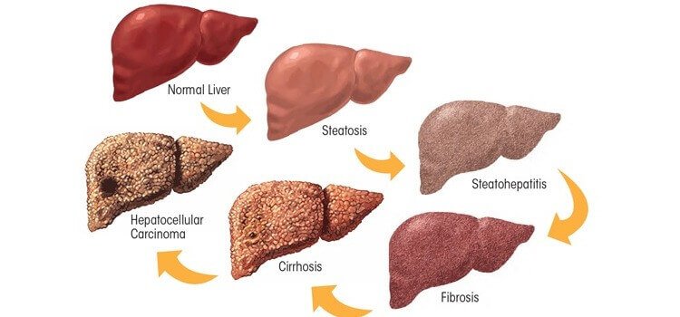 Alcoholic liver disease stages illustration showing normal liver, fatty liver, fibrosis, cirrhosis and liver cancer progression