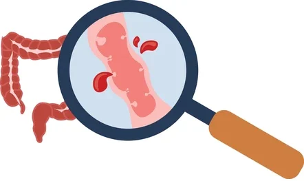 Gastrointestinal bleeding illustration showing bleeding inside colon