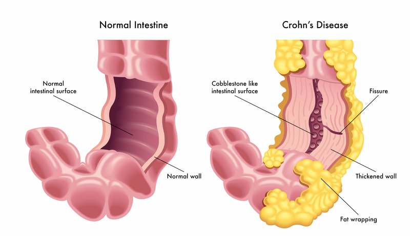 Comparison of normal intestine and Crohn’s disease showing inflamed intestinal wall, fissures, and thickening in Crohn’s disease