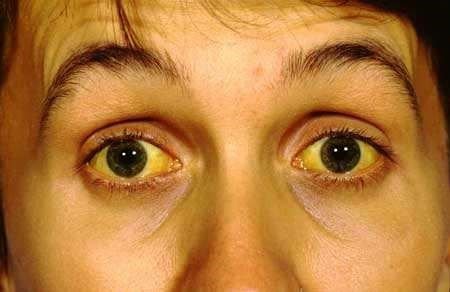 Yellow eyes symptom of jaundice caused by high bilirubin and liver disorder