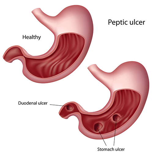 Peptic ulcer disease treatment illustration showing stomach ulcer and duodenal ulcer