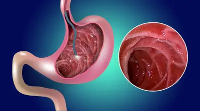 Bile duct obstruction treatment illustration showing blocked bile duct and endoscopic removal