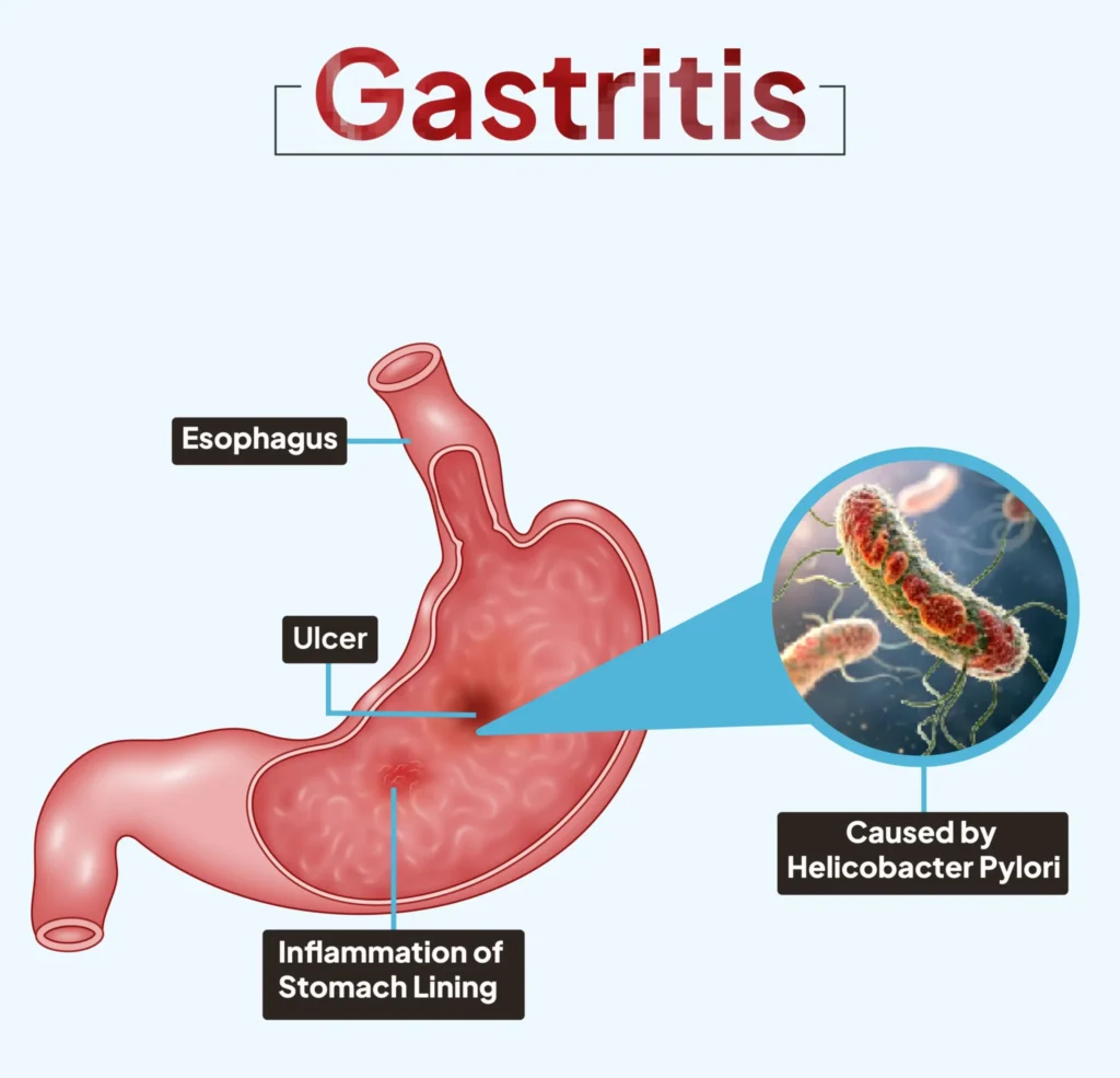 Gastritis treatment illustration showing stomach inflammation and H pylori infection
