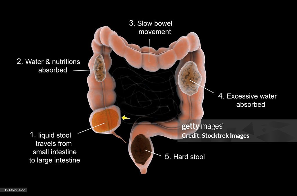 Constipation diagram showing slow bowel movement and hard stool formation in large intestine