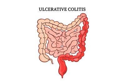 Inflammatory bowel disease IBD treatment illustration showing ulcerative colitis colon