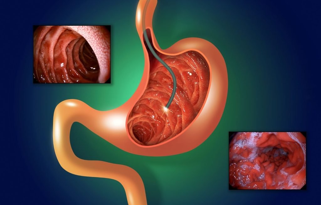 Gastrointestinal bleeding treatment using endoscopy for stomach bleeding