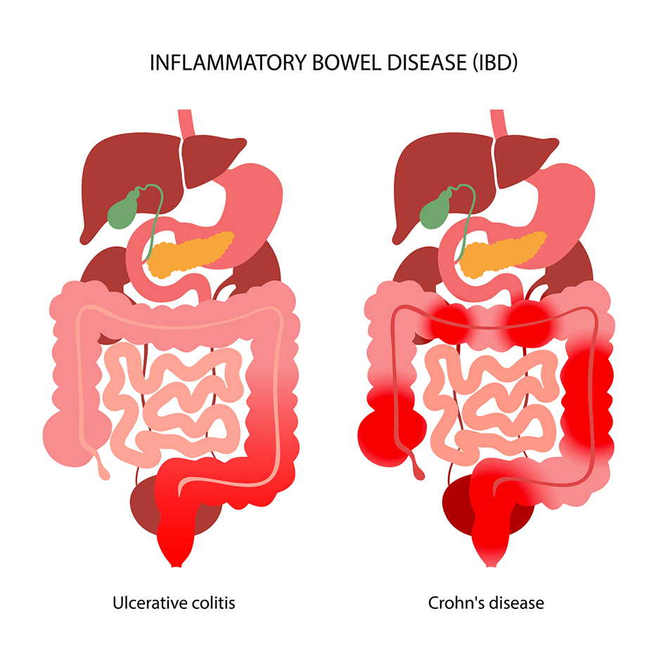 Inflammatory bowel disease IBD treatment illustration showing ulcerative colitis and Crohn’s disease