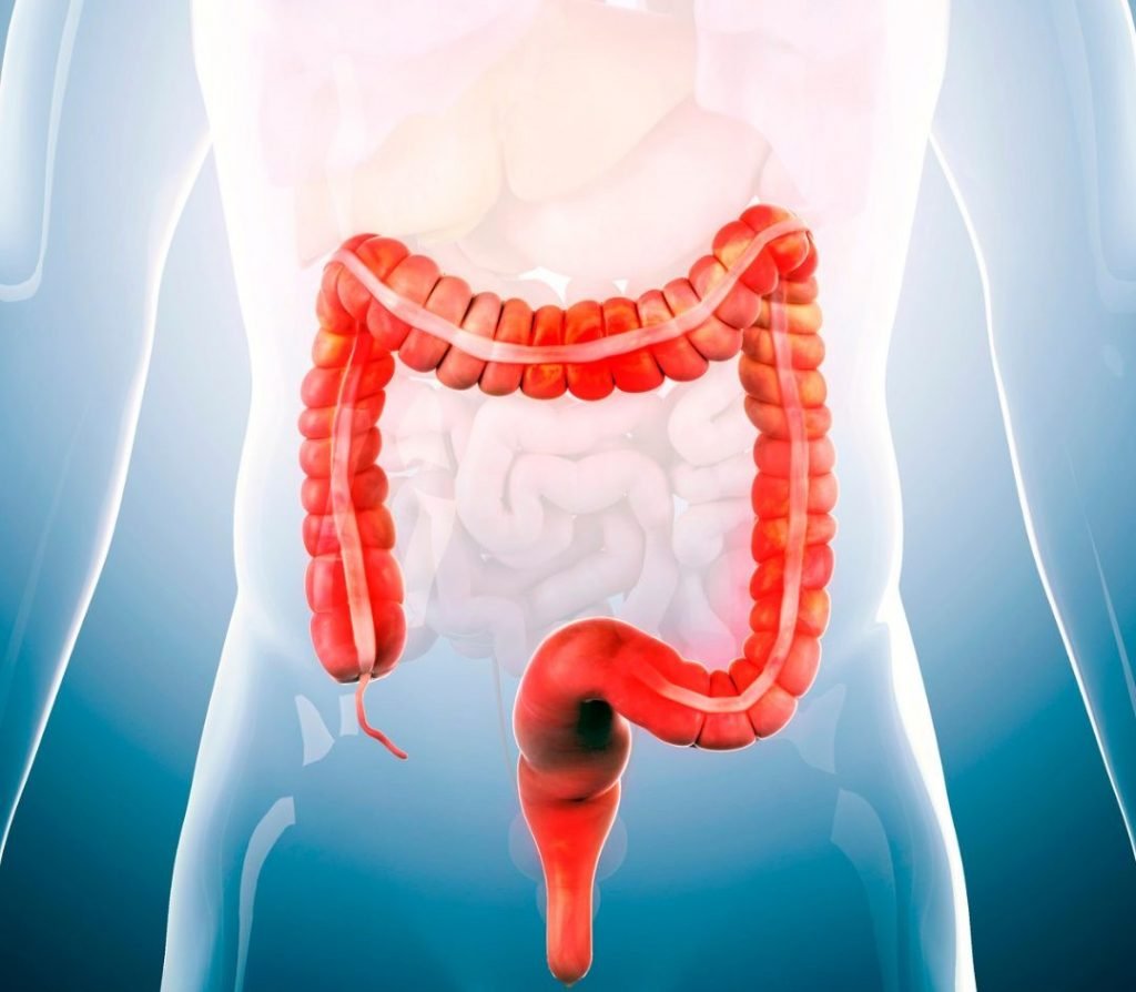 Illustration of large intestine highlighting irritable bowel syndrome IBS and digestive tract inflammation