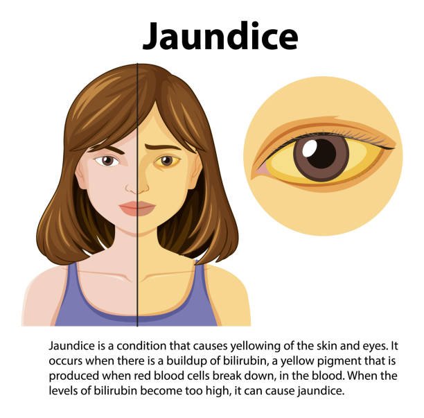 Jaundice symptoms showing yellowing of skin and eyes due to high bilirubin levels