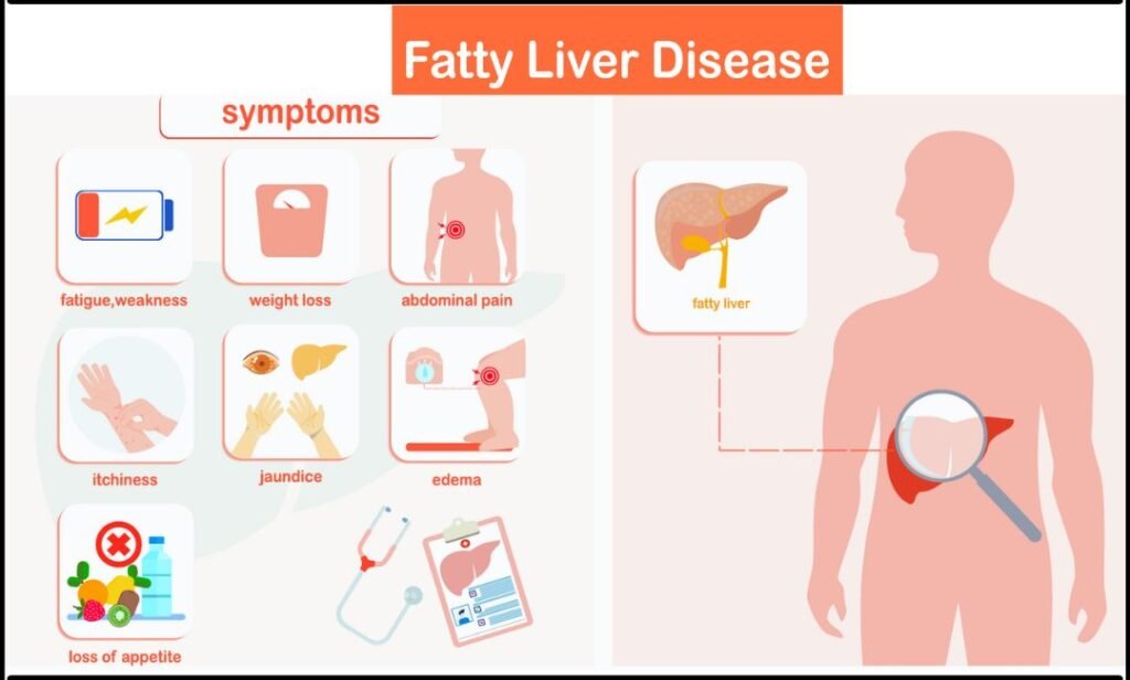 Fatty liver disease symptoms including fatigue, jaundice, abdominal pain and edema