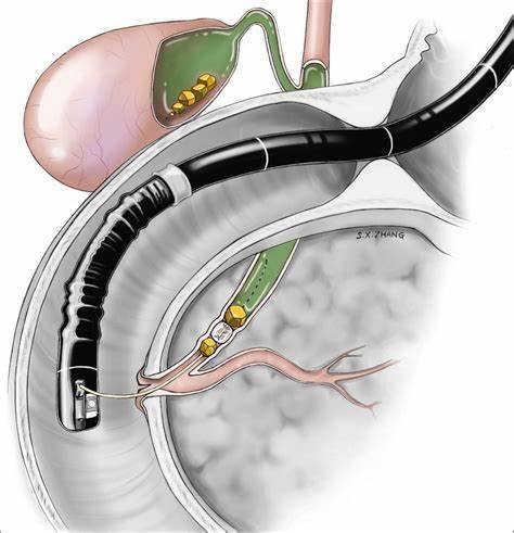 ERCP endoscopy procedure for bile duct stone removal and pancreatic treatment