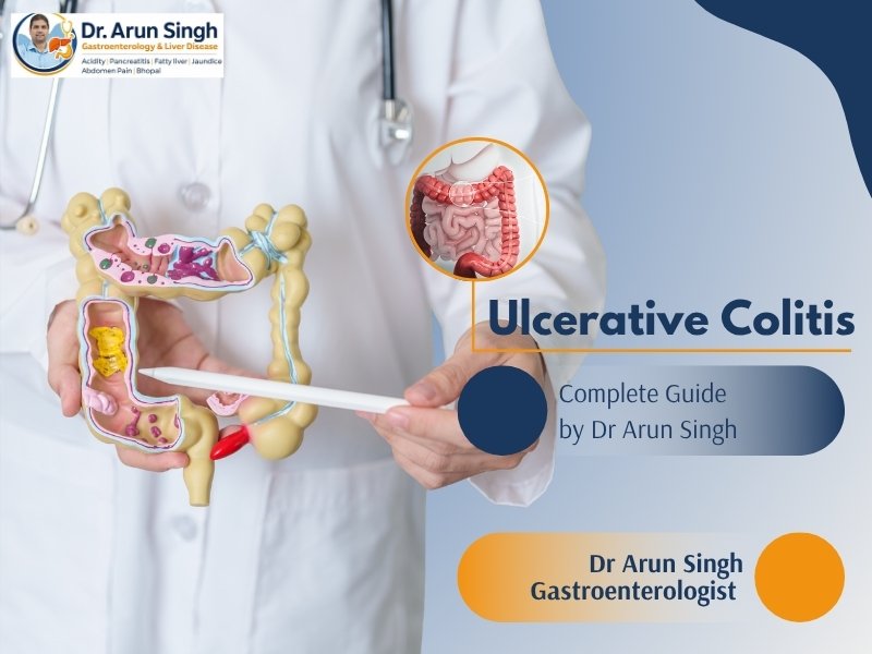 Ulcerative colitis illustration showing inflamed colon with medical explanation by Dr Arun Singh for Ulcerative Colitis treatment in Bhopal